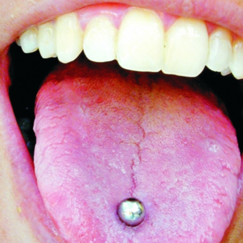Piercing na língua: complicações chegam até o coração
